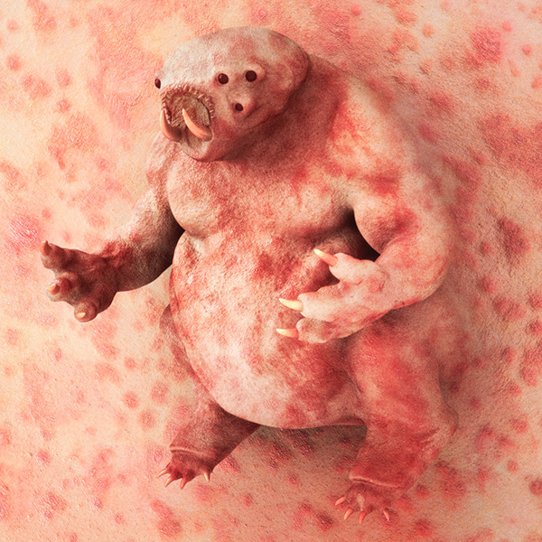 Eczema Monsters