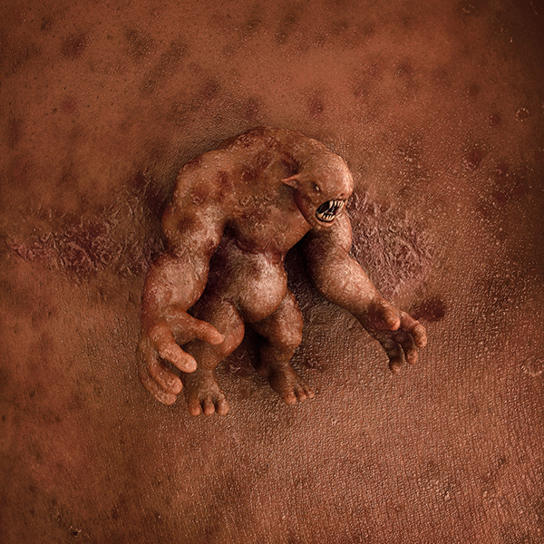 Eczema Monsters