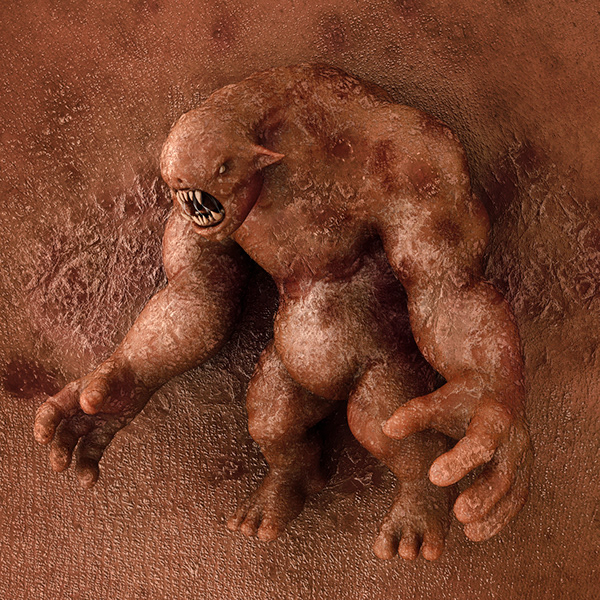 Eczema Monsters