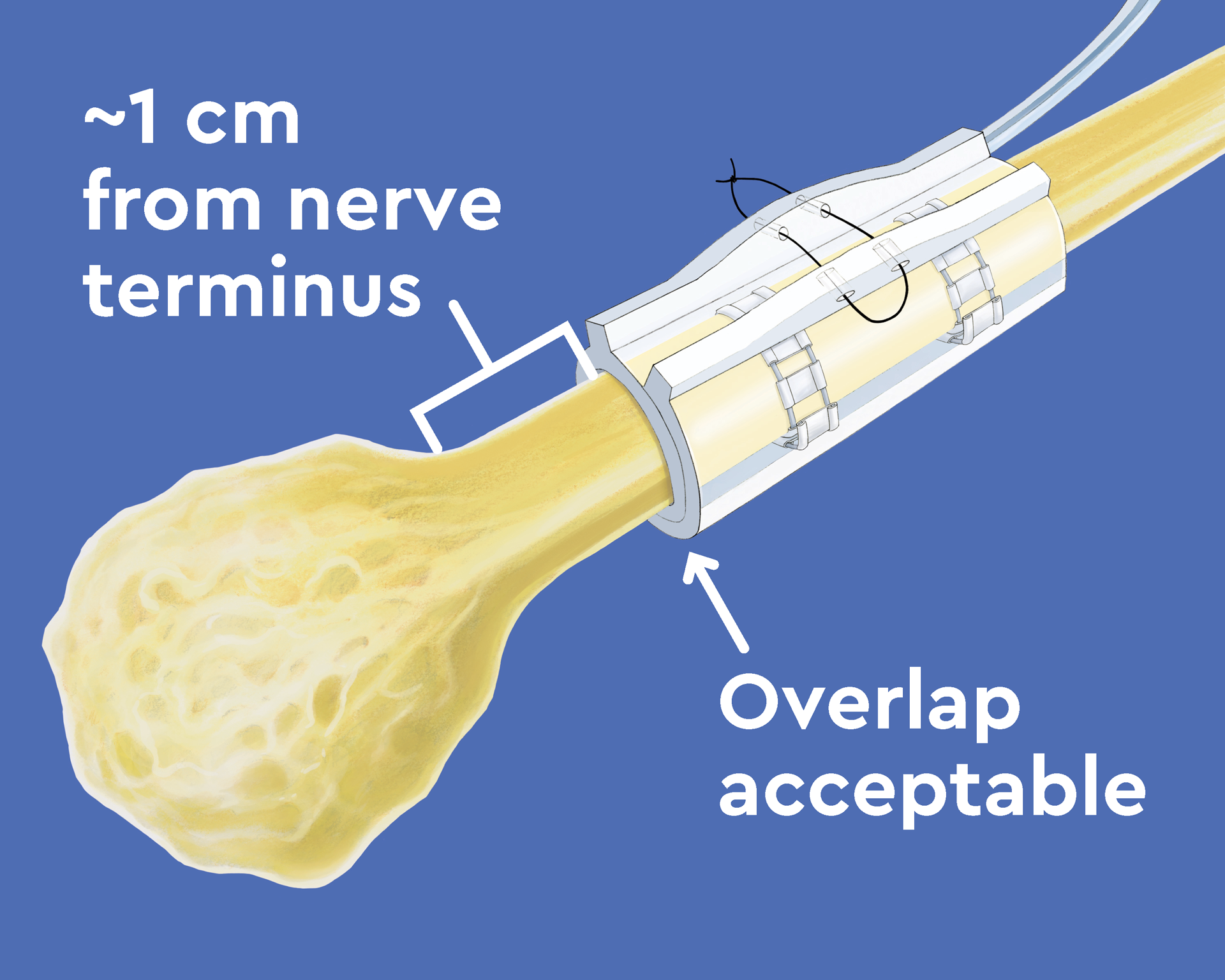 Neuros Medical Animation